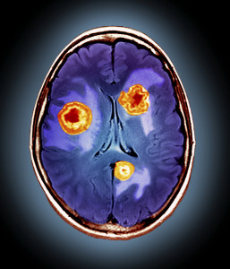 Secondary brain cancer, MRI scan