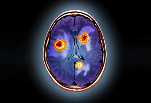 Image from Licence Details: Delivering therapeutics to hard-to-treat secondary brain tumours
