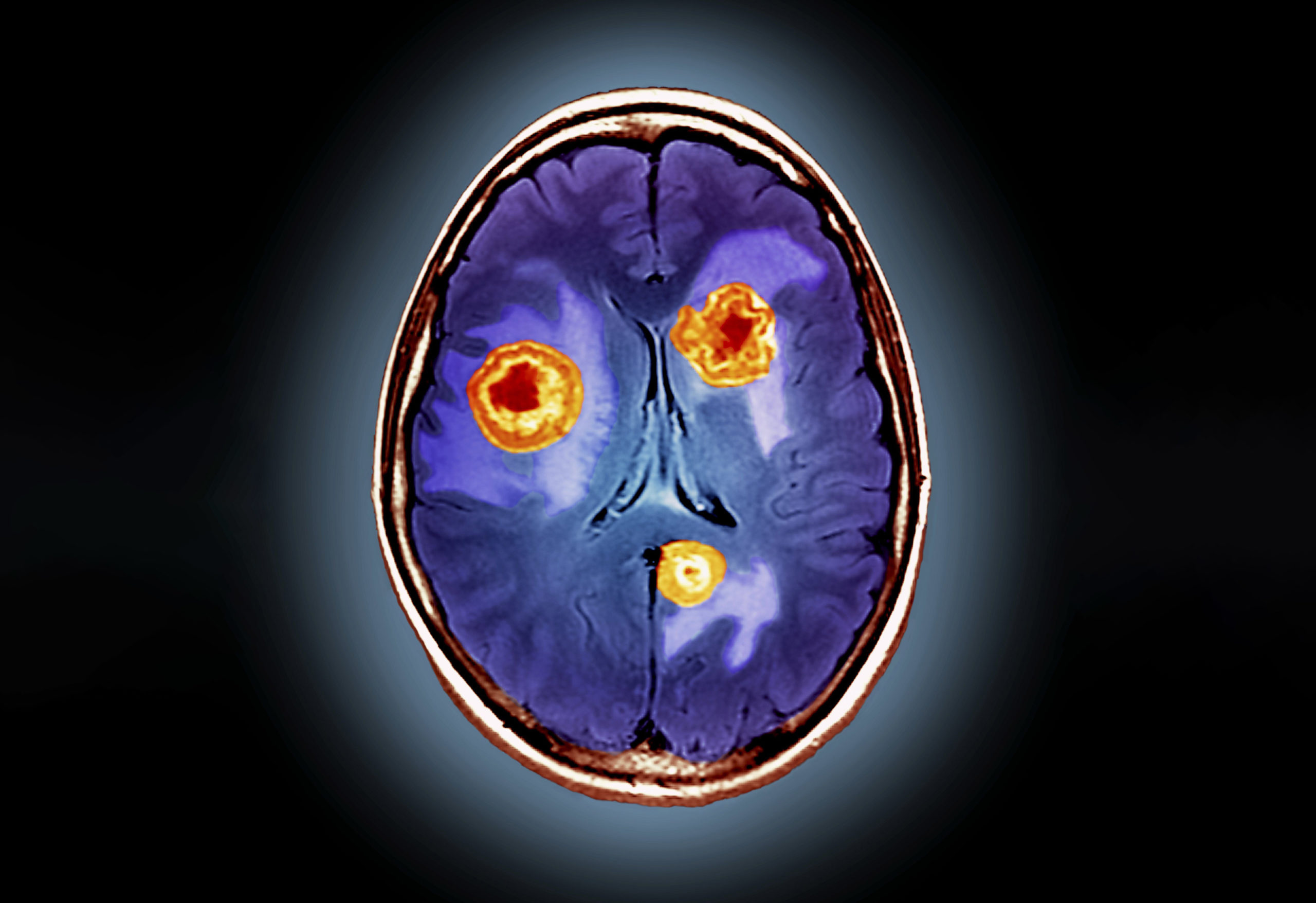 brain-tumor-stages-tnm-stages-and-metastasis-onco