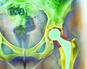 Hip Replacement Scan