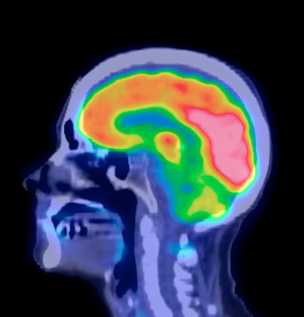 Human brain, PET scan Oxford University Innovation