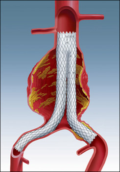 Stent Grafts: 2003 Medical Futures Innovation Awards