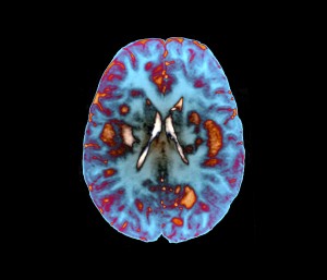 Image from Licence Details: Diagnosing Neurological Autoimmune Disease
