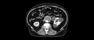 Image from Licence Details: Growth prediction of abdominal aortic aneurysms