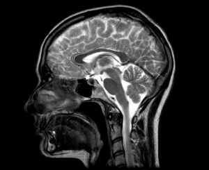 Image from Licence Details: Using inorganic nitrites as a marker for brain injuries caused by a stroke