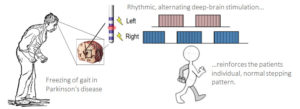 Image from Licence Details: Alternating deep-brain-stimulation for treatment of gait disturbances