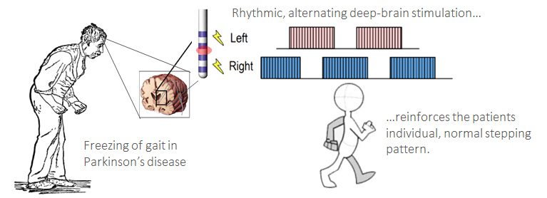 Alternating deep-brain-stimulation for treatment of gait disturbances ...